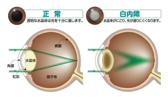 白内障の原因と治療・手術 | 横浜市上星川・和田町の保土ケ谷いいな